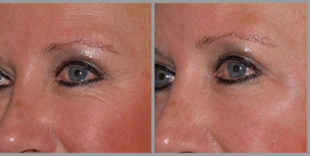 BOTOX AROUND EYES Botox Eyes Before And After Results Botox Eyes