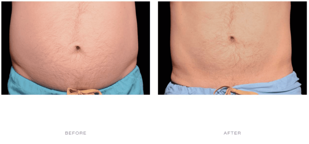 CoolSculpting Does It Work On Belly Fat CoolSculpting Belly Fat