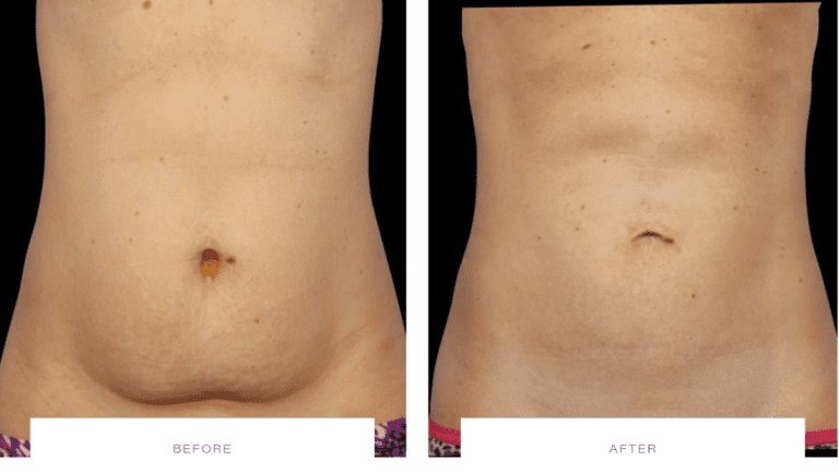 CoolSculpting Does It Work On Belly Fat CoolSculpting Belly Fat