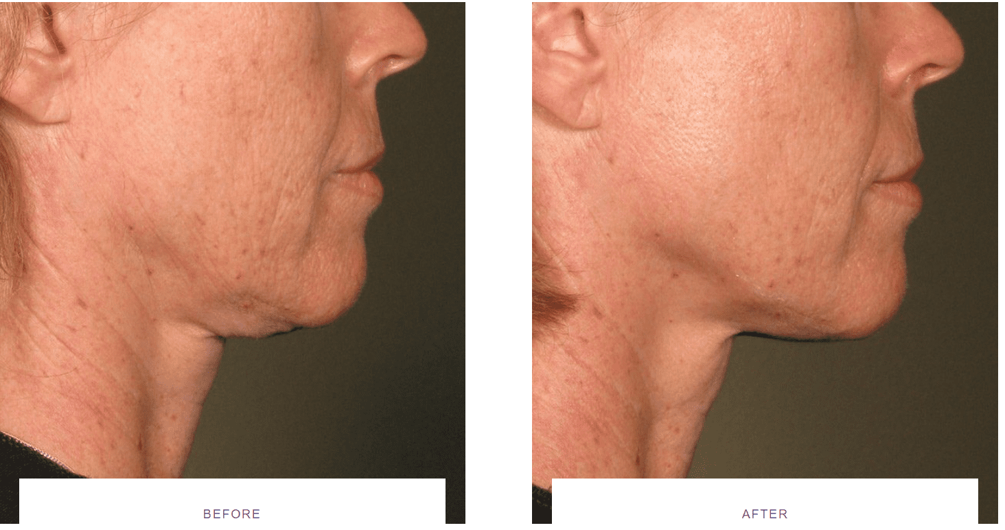 Laser Skin Tightening Before And After Thermage Morpheus8 Ultherapy