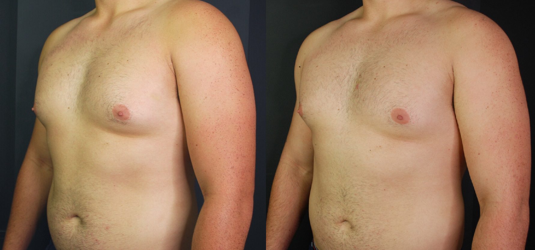 CoolSculpting Fat Freezing Before And After Photos CoolSculpting