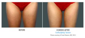 The Body Image Project - thigh gap - DepthDepth