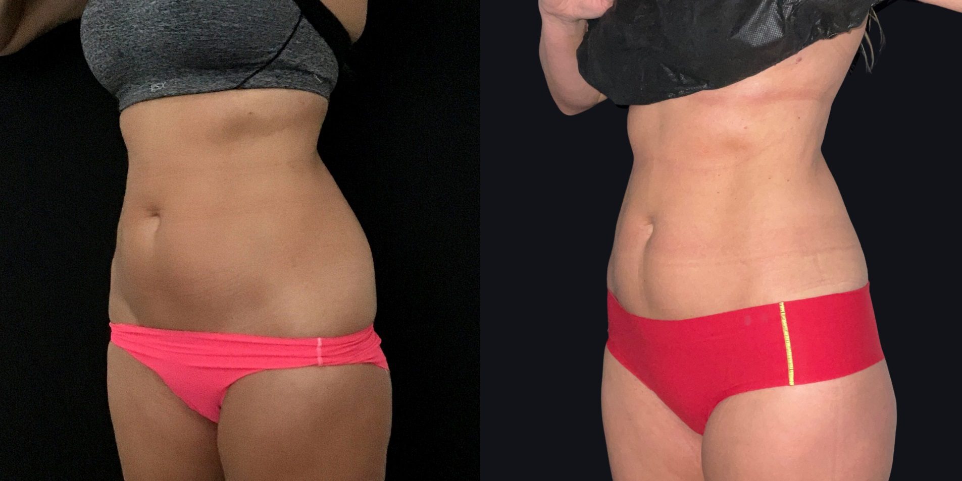 Coolsculpting Fat Freezing Before And After Photos Coolsculpting