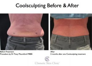 What Is Coolsculpting - Fat Freezing? - The Cosmetic Skin Clinic