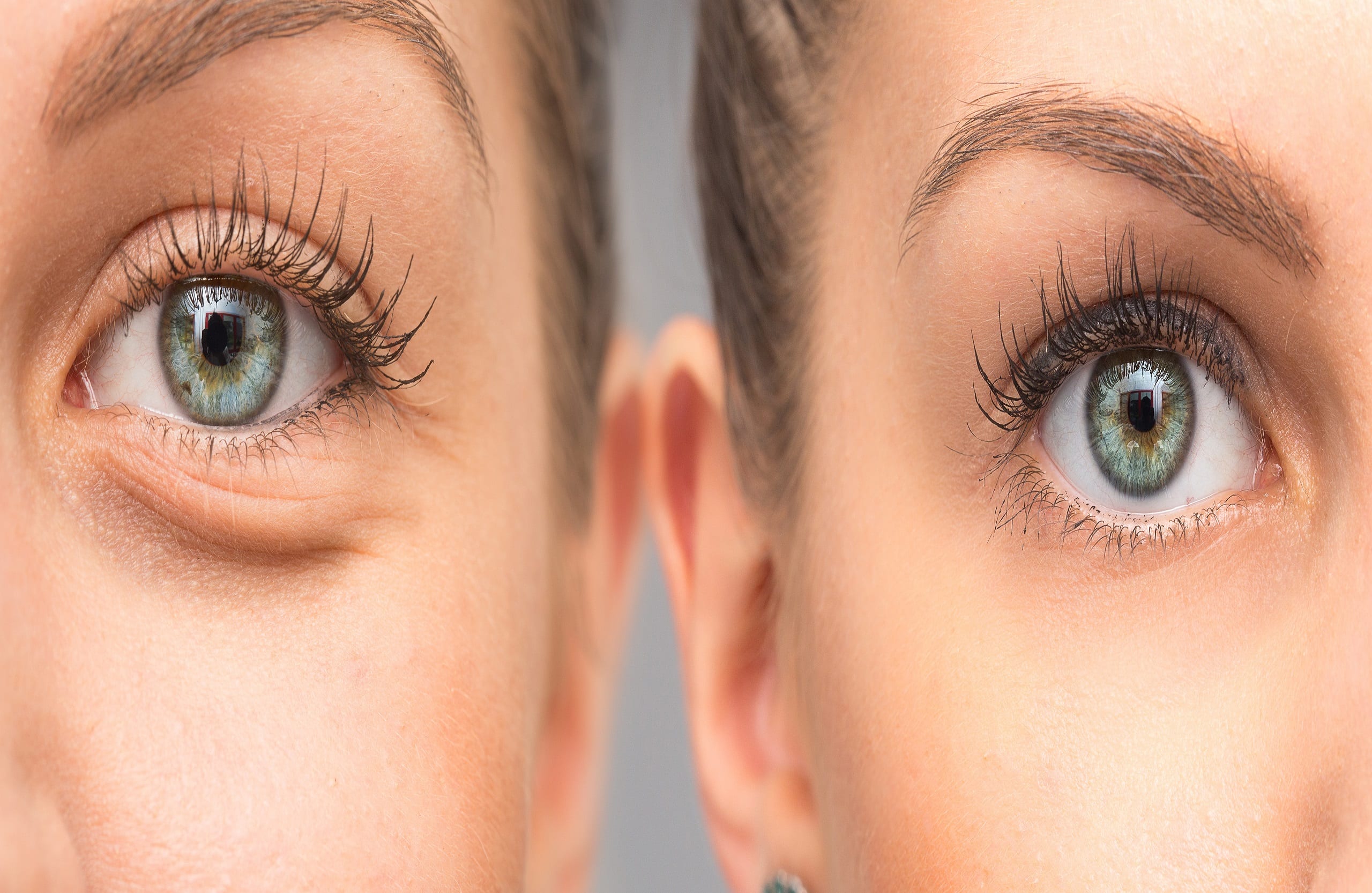 How to Get Rid of Under Eye Bags: Causes and Effective Solutions