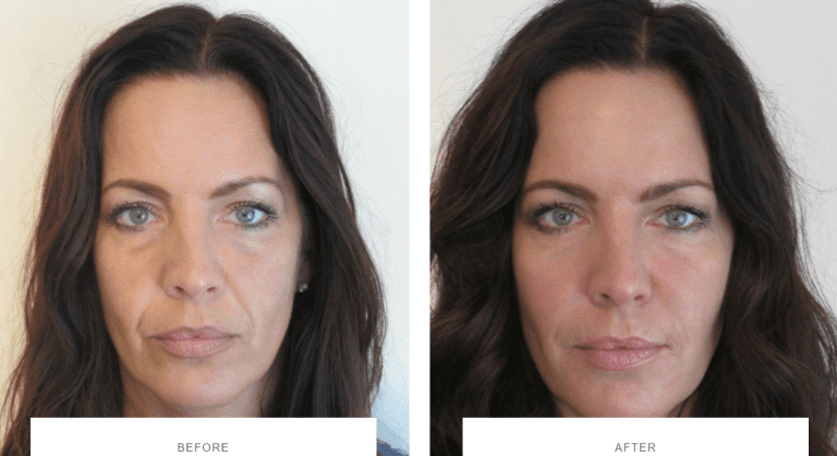 Dermal Fillers Harley Street Facial Fillers Under Eye Filler Harley