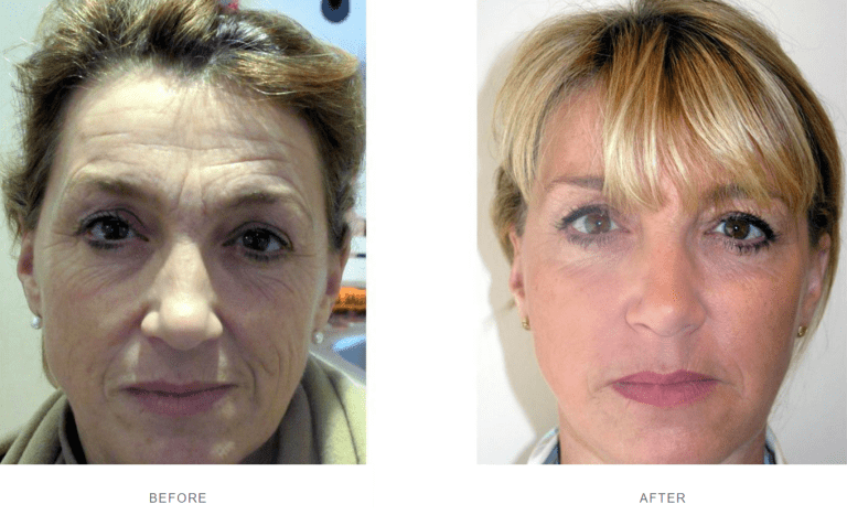 Dermal Fillers Harley Street Facial Fillers Under Eye Filler Harley