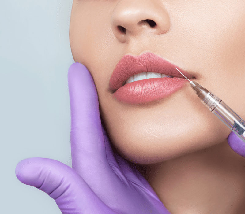 Juvederm Fillers London