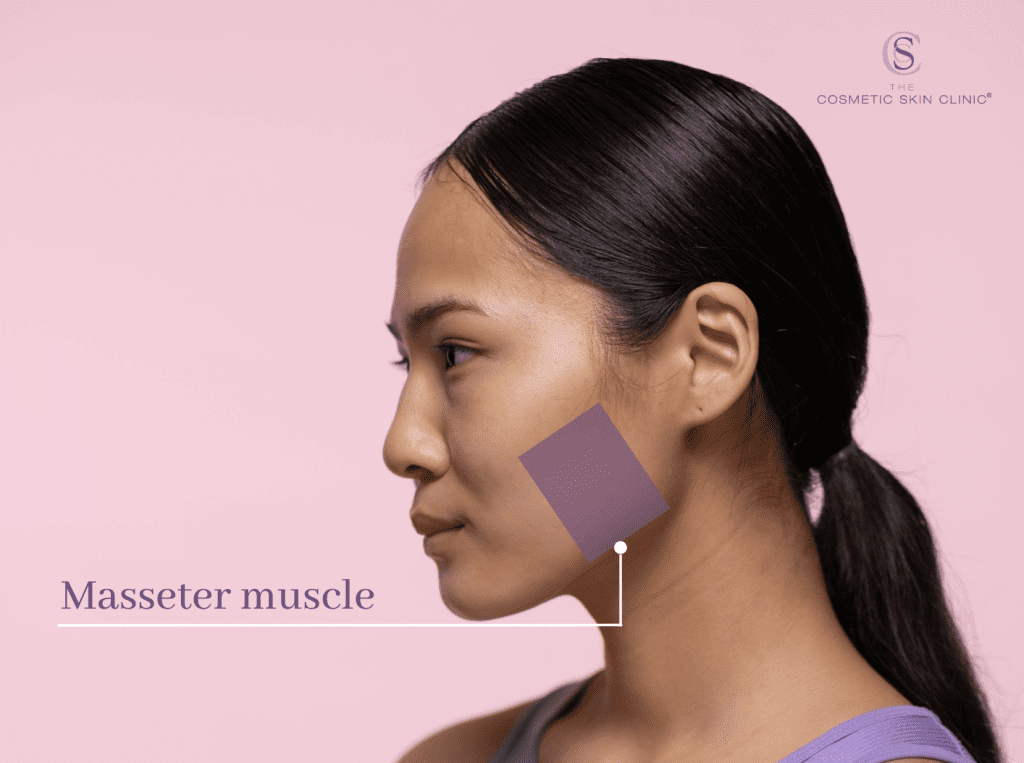 Masseter Botox: How to treat teeth grinding with Botox and reduce