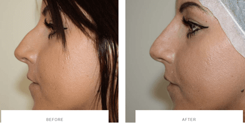 The Art of Nose Slimming with Muscle Relaxants: A Non-Surgical