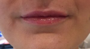 thinnest lips in the world