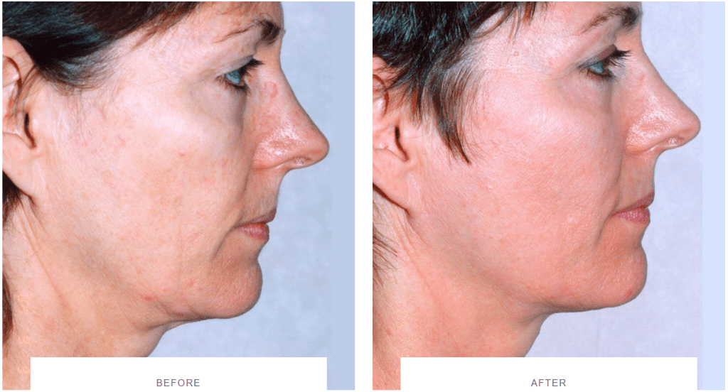 Laser Skin Tightening before and after - Thermage, Morpheus8