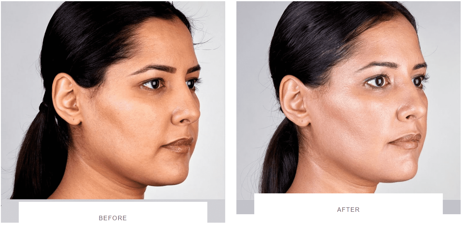 Laser Skin Tightening before and after - Thermage, Morpheus8, Ultherapy ...