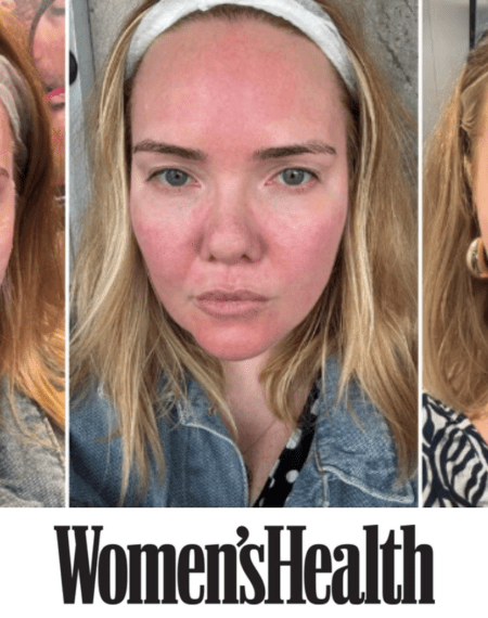 Women’s Health: I had a Moxi Laser treatment to get “Korean glass skin” and the results blew me away