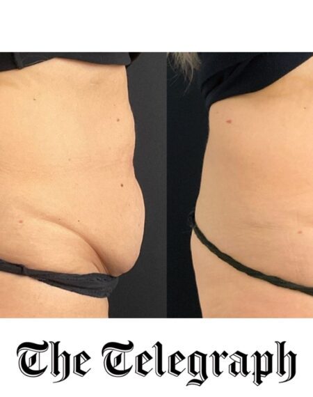 The Telegraph: The health risks of having an apron belly and how to get rid of it