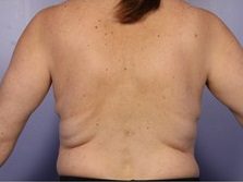 CoolSculpting to Reduce Back Fat