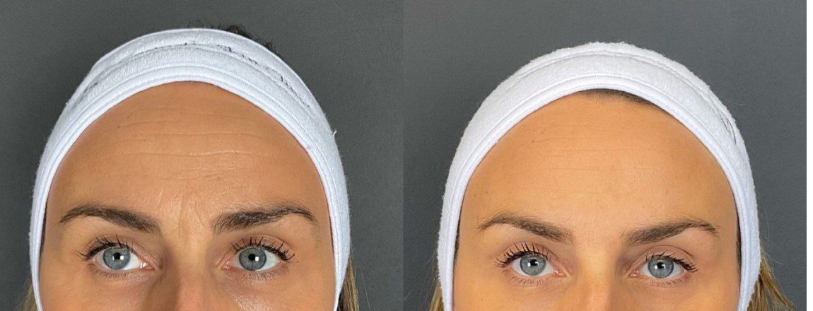 Botox Forehead Before and After: Key Botox injection points and the ...