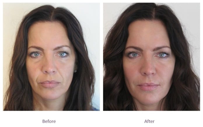 Chin Fillers Before And After Receding Chin Sagging Skin On Chin