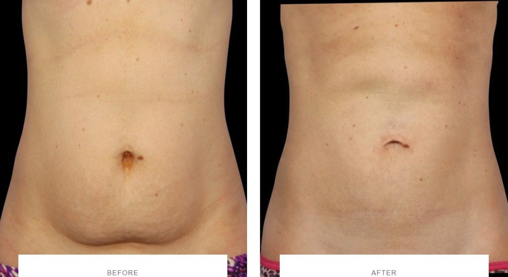 Coolsculpting Belly Fat Before And After 1 1024x558 