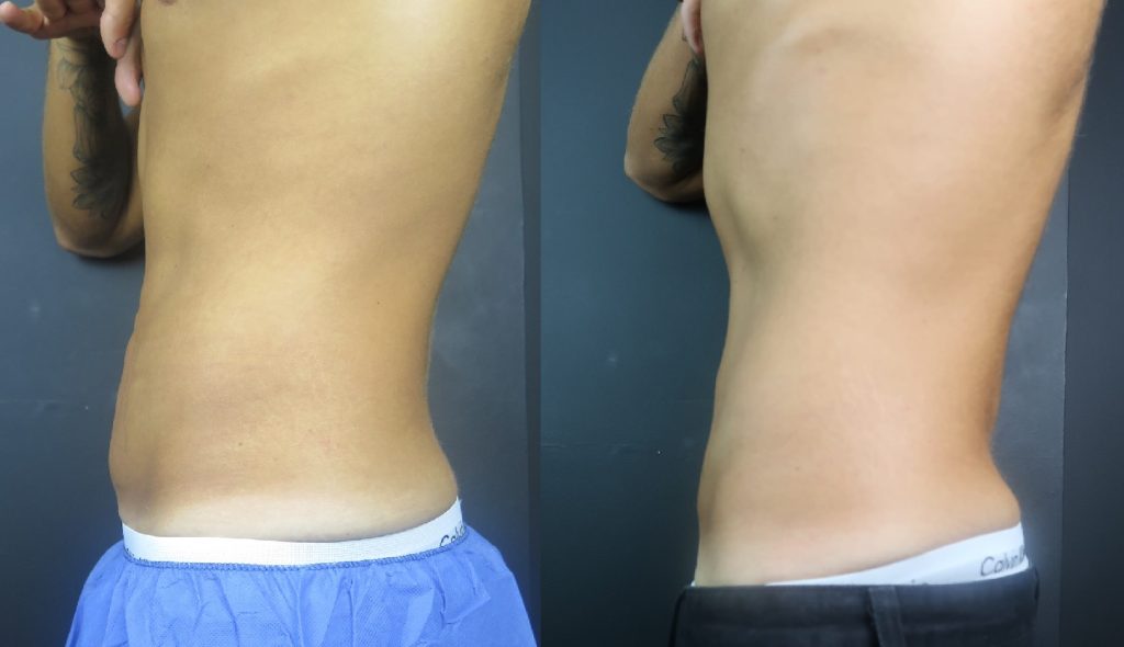 https://www.cosmeticskinclinic.com/wp-content/uploads/coolsculpting-belly-fat-before-and-after-1024x590.jpg