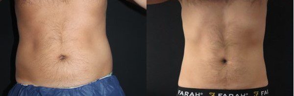 CoolSculpting Fat Freezing Before and After Photos, CoolSculpting London,  Buckinghamshire