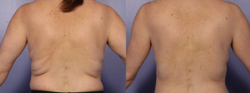 https://www.cosmeticskinclinic.com/wp-content/uploads/coolsculpting-fat-freezing-before-and-after-back-fat-1024x384.jpg