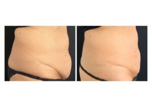 coolsculpting fat freezing belly fat before after results