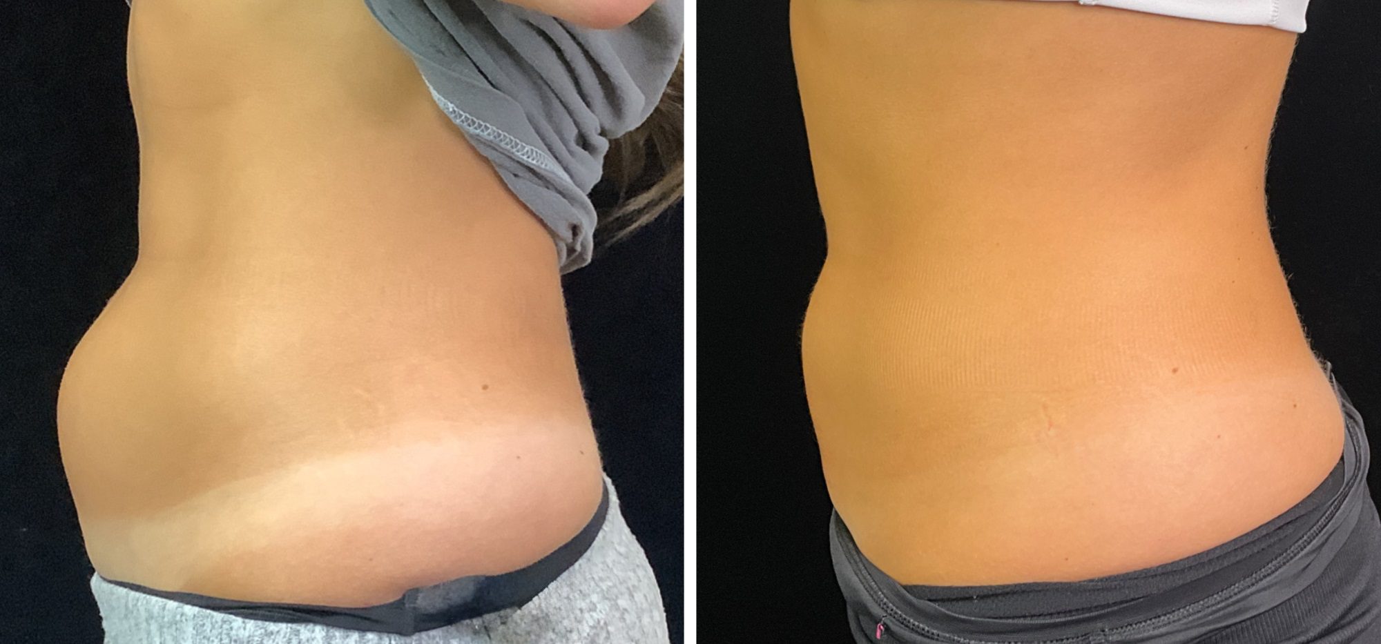 CoolSculpting Fat Freezing Before And After Photos CoolSculpting London Buckinghamshire The