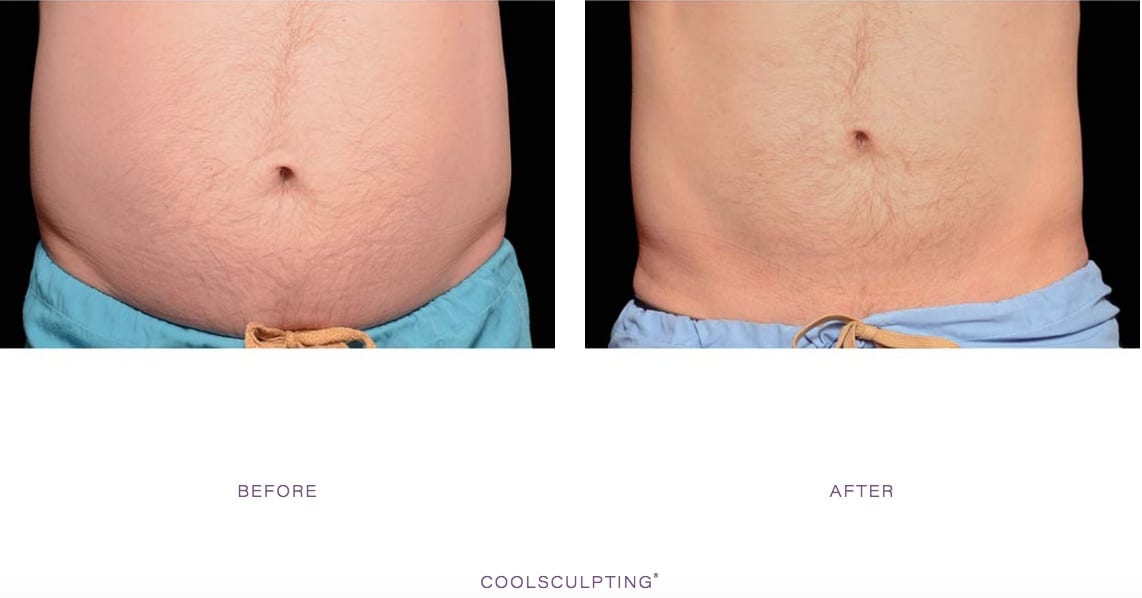 CoolSculpting Male Lower Abdomen Before After Pictures, Men Flanks