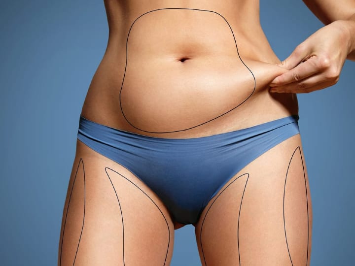 Women Thigh Shaper After Post Liposuction Fat Filling Double