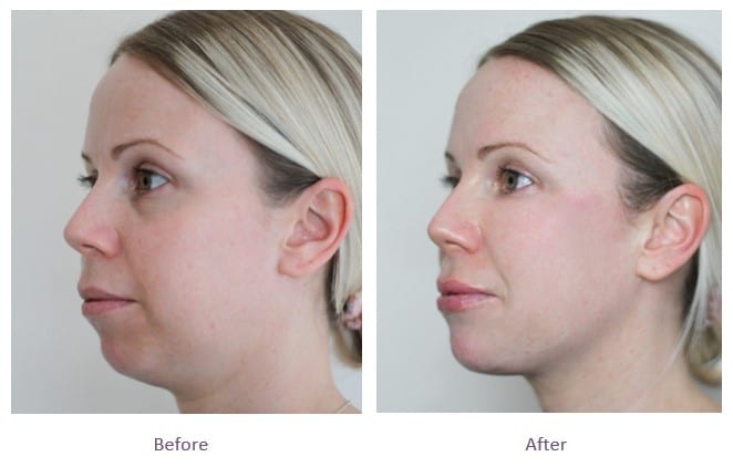 The Non-Invasive Facelift for that Perfectly Sculpted Jaw - Cutera