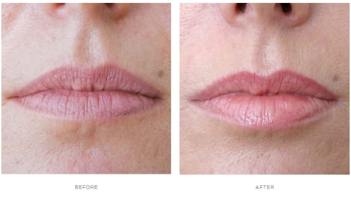 Straws to minimize lip lines as part of our antiaging easy fixes