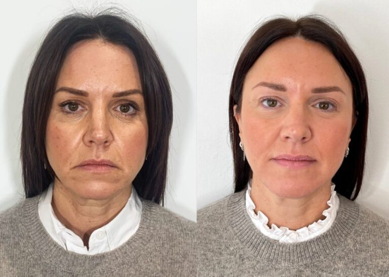 The Best Way to Fix Downturned Mouth Corners | Filler, Botox for ...