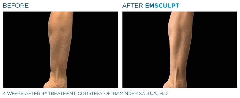 Maximizing Your EMsculpt Neo Experience: Insights from My Personal
