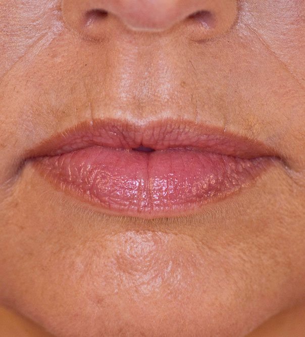 Before & After Lip Enhancement | The Cosmetic Skin Clinic