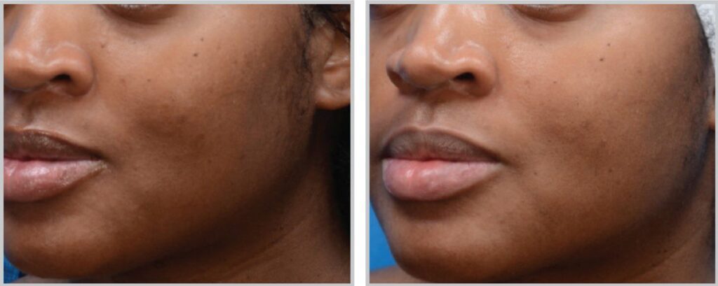 moxi laser before and after dark spots treatment