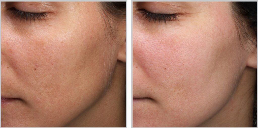 moxi laser before and after face treatment