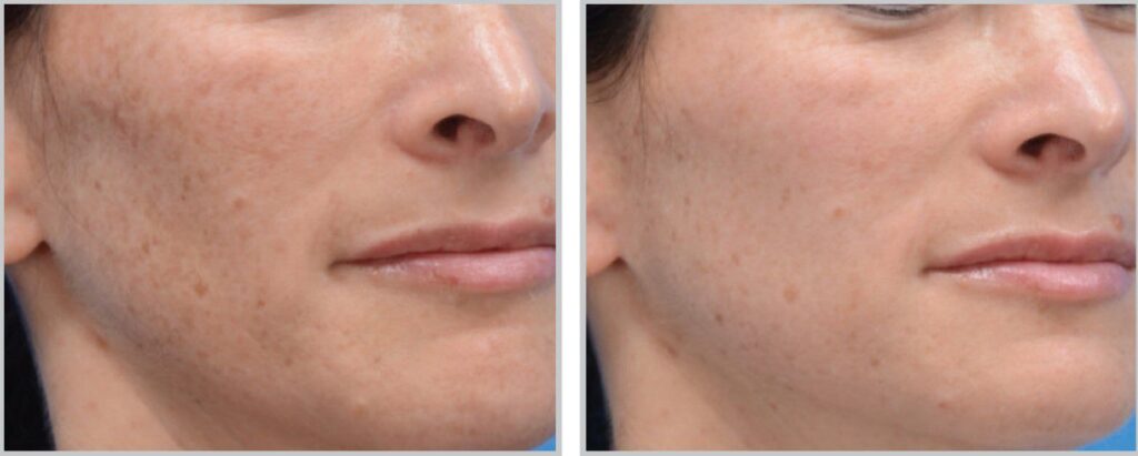 moxi laser before and after hyperpigmentation treatment