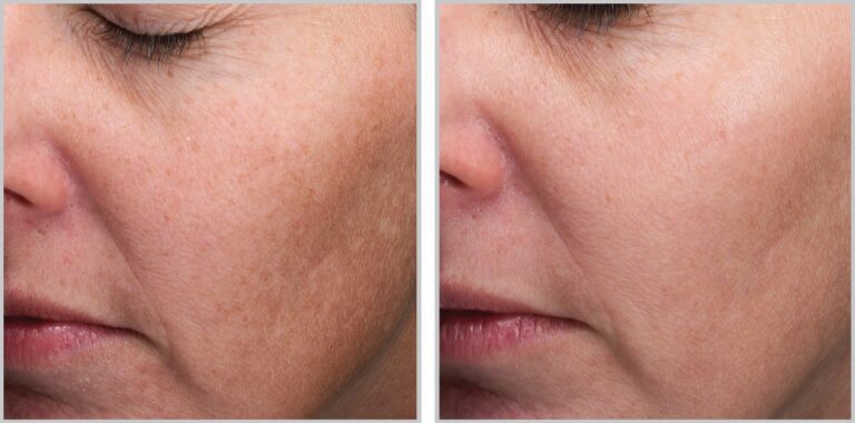 moxi laser before and after sun spots and hyperpigmentation treatment