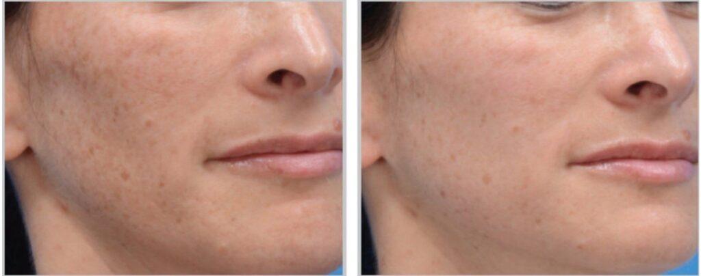 moxi laser cheeks before and after results