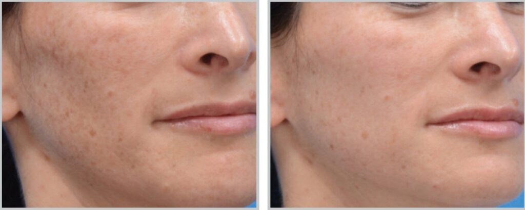 moxi-laser-face-hyperpigmentation-before-and-after