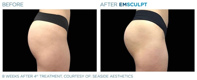 https://www.cosmeticskinclinic.com/wp-content/uploads/non-surgical-butt-lift-before-and-after.jpg