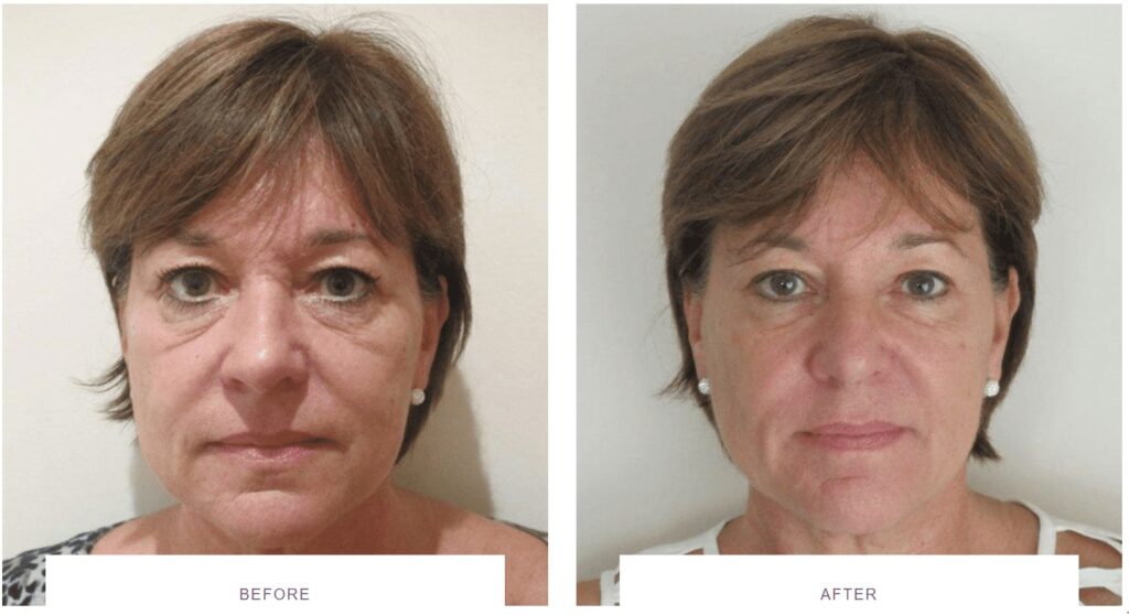 tear trough filler before and after or polynucleotides under eyes