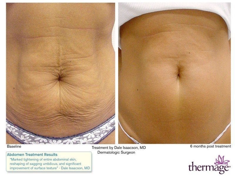 Thermage Before and After, Thermage Skin Tightening, Thermage near me -  London, Buckinghamshire