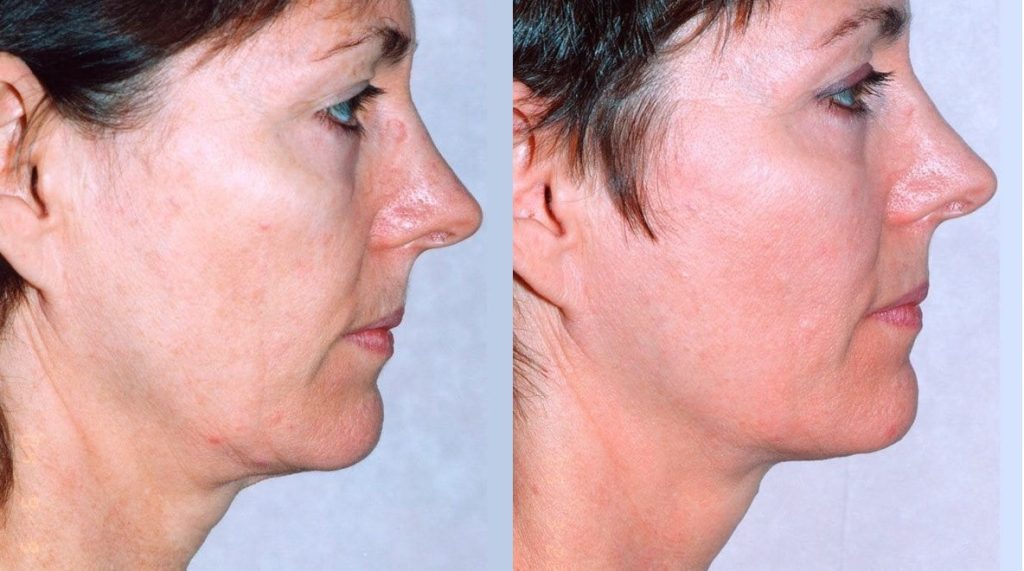 The Skin Tightening Treatment That Beats Surgery (And the Technology That  Lies Behind It)