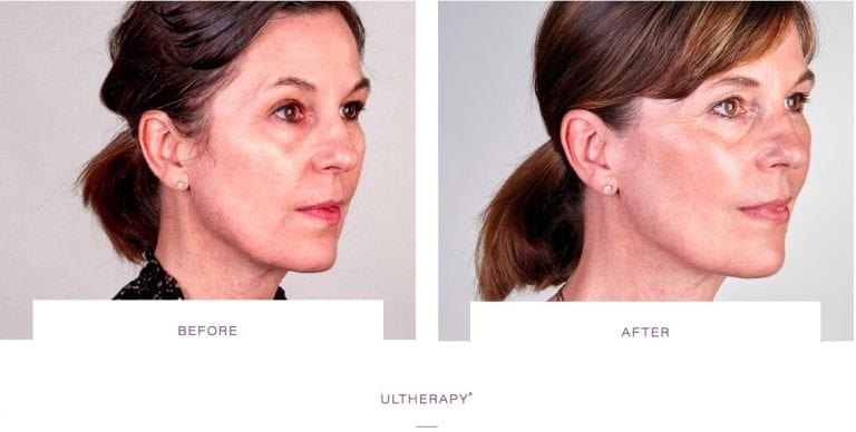 Laser Skin Tightening before and after - Thermage, Morpheus8, Ultherapy Skin  Tightening in London, Buckinghamshire
