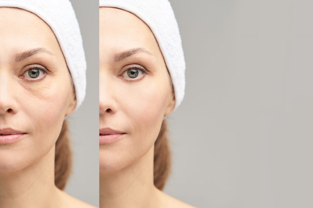 Non Surgical Cosmetic Procedures To Treat Dark Circles Hollows And Bag –  ReNue